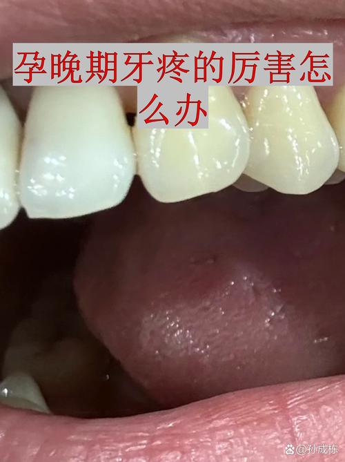 怀孕期间牙疼怎么快速止疼？对胎儿安全吗？-第2张图片-郑州医学网