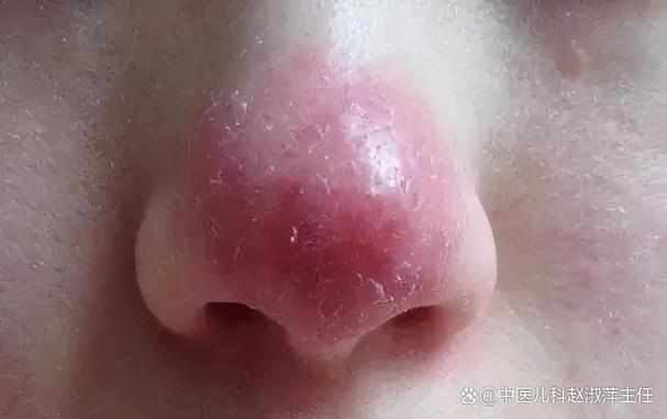 怀孕期间鼻子特别敏感，是激素变化捣的鬼吗？-第3张图片-郑州医学网