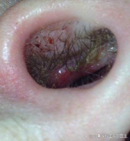 怀孕期间鼻子特别敏感，是激素变化捣的鬼吗？-第2张图片-郑州医学网