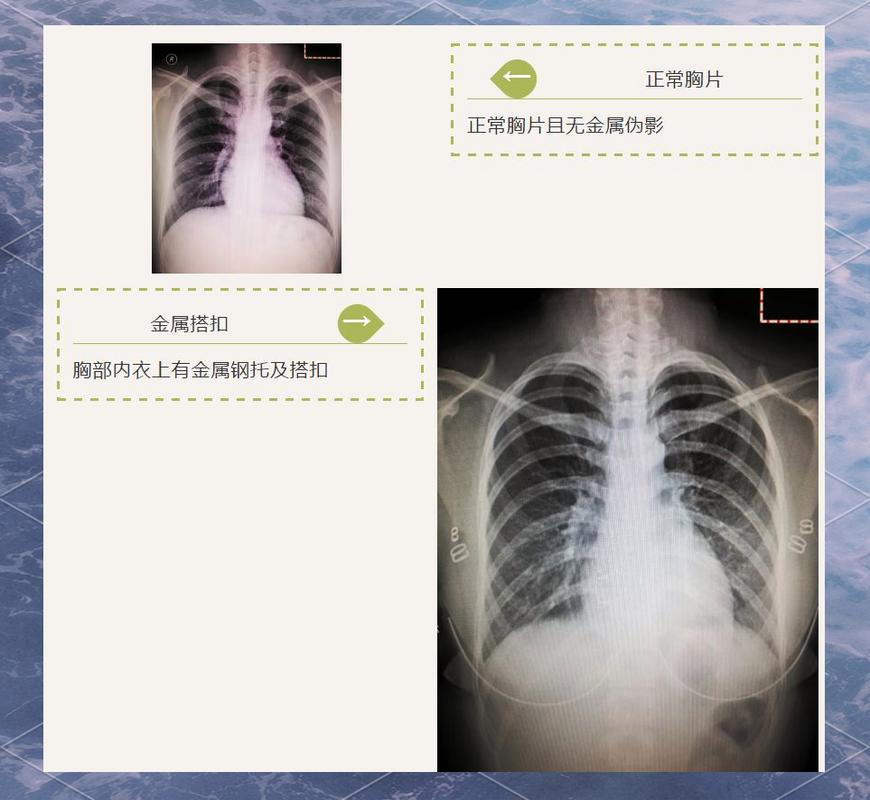 孕期拍过胸片会对胎儿有影响吗?需要做哪些检查来排查风险?-第1张图片-郑州医学网 孕期拍过胸片会对胎儿有影响吗?需要做哪些检查来排查风险?-第1张图片-郑州医学网