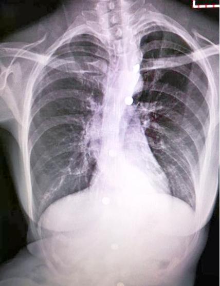 孕期拍过胸片会对胎儿有影响吗？需要做哪些检查来排查风险？-第2张图片-郑州医学网