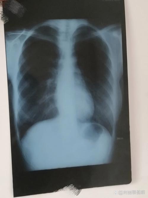 孕期拍过胸片会对胎儿有影响吗？需要做哪些检查来排查风险？-第3张图片-郑州医学网