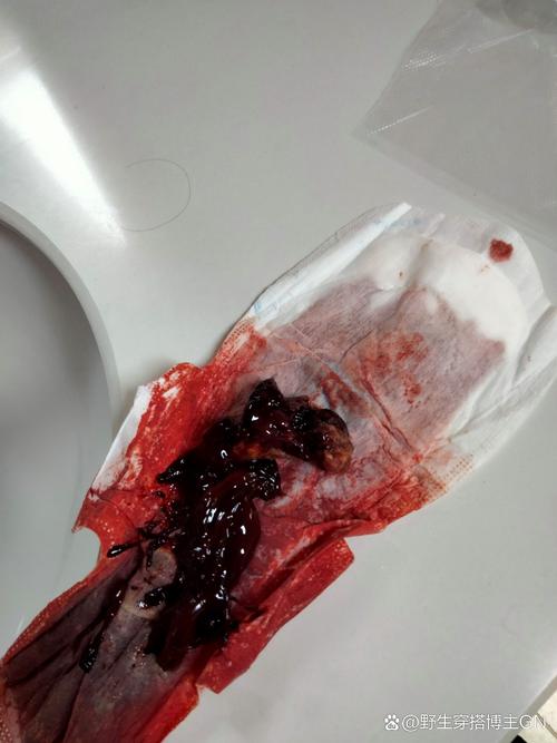 孕期流鲜红的血却没有腹痛,这是怎么回事?会对宝宝有危险吗?-第1张图片-郑州医学网 孕期流鲜红的血却没有腹痛,这是怎么回事?会对宝宝有危险吗?-第1张图片-郑州医学网