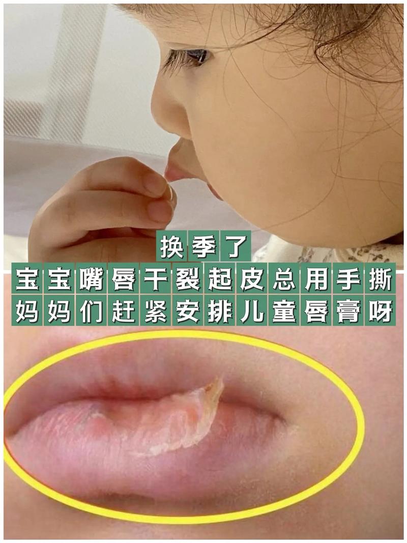 儿童嘴唇干裂是缺水、过敏还是疾病信号？家长该如何科学应对？-第3张图片-郑州医学网