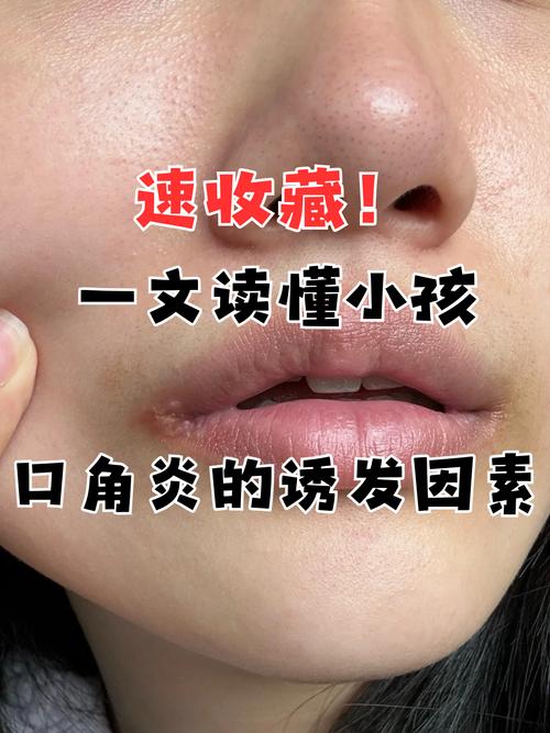 儿童嘴唇干裂是缺水、过敏还是疾病信号？家长该如何科学应对？-第2张图片-郑州医学网