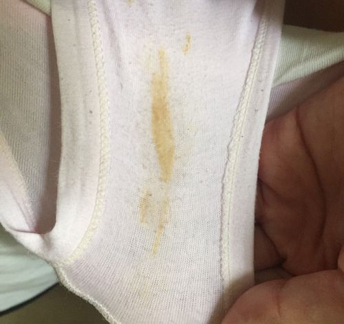 怀孕期间白带发黄又多，是正常现象还是感染信号？-第1张图片-郑州医学网