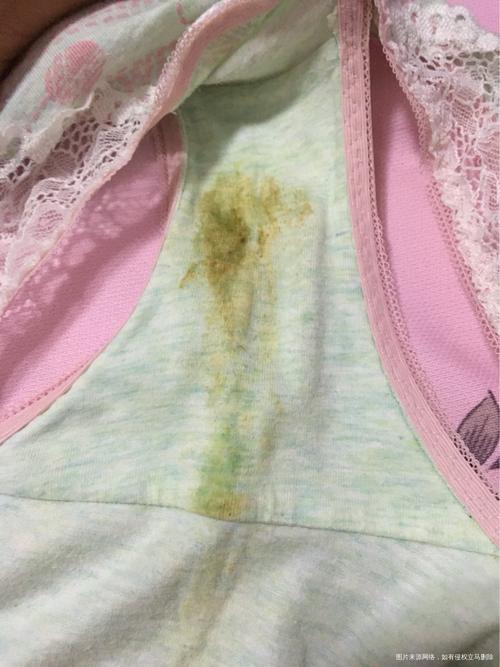 怀孕期间白带发黄又多，是正常现象还是感染信号？-第2张图片-郑州医学网