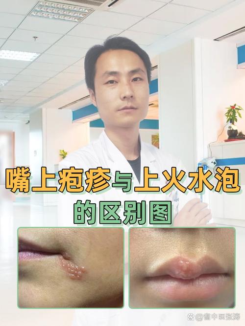 孕期嘴巴长疱疹会影响胎儿吗？该如何安全处理？-第2张图片-郑州医学网