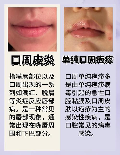 孕期嘴巴长疱疹会影响胎儿吗?该如何安全处理?-第1张图片-郑州医学网 孕期嘴巴长疱疹会影响胎儿吗?该如何安全处理?-第1张图片-郑州医学网