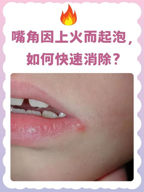 孕期嘴巴长疱疹会影响胎儿吗？该如何安全处理？-第3张图片-郑州医学网