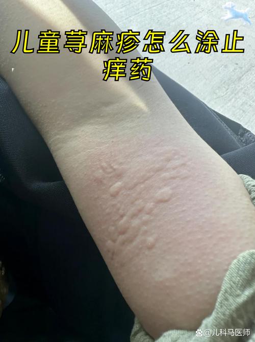 儿童荨麻疹图片和症状有哪些？不同年龄段症状差异大吗？-第3张图片-郑州医学网