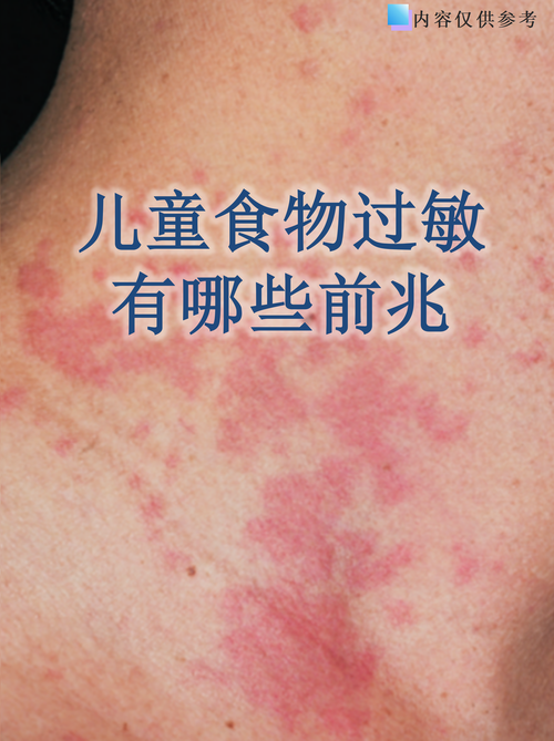 儿童荨麻疹图片和症状有哪些？不同年龄段症状差异大吗？-第2张图片-郑州医学网