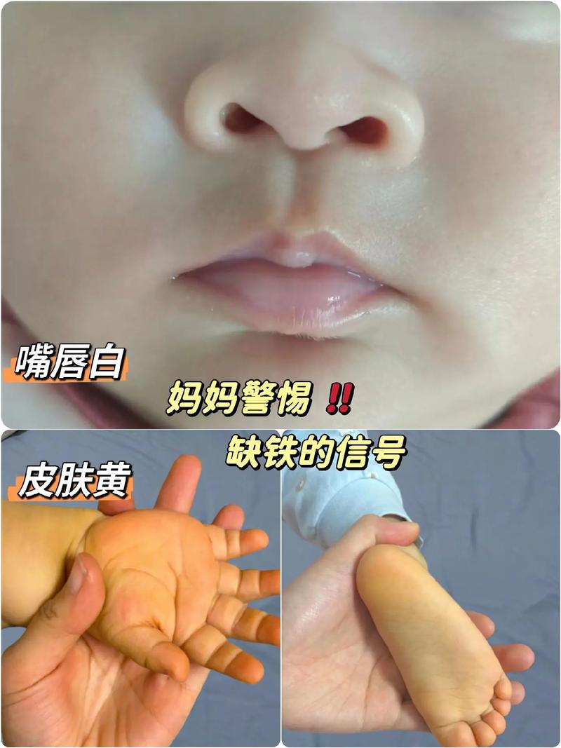 新生儿嘴唇起白泡是缺乏营养还是其他疾病信号？-第1张图片-郑州医学网