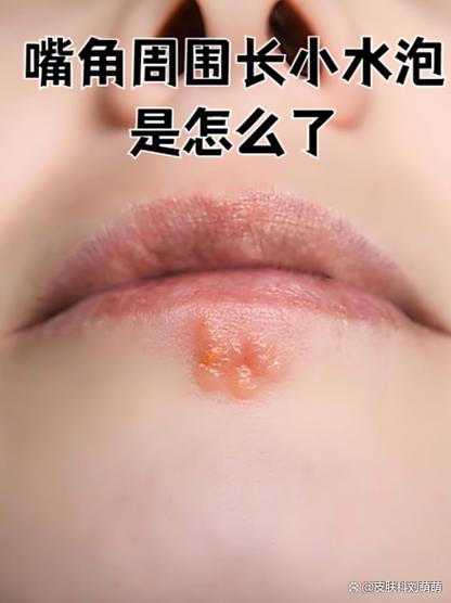 新生儿嘴唇起白泡是缺乏营养还是其他疾病信号？-第2张图片-郑州医学网