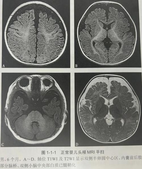 新生儿为什么需要做磁共振检查？这安全吗？哪些情况必须做？-第2张图片-郑州医学网