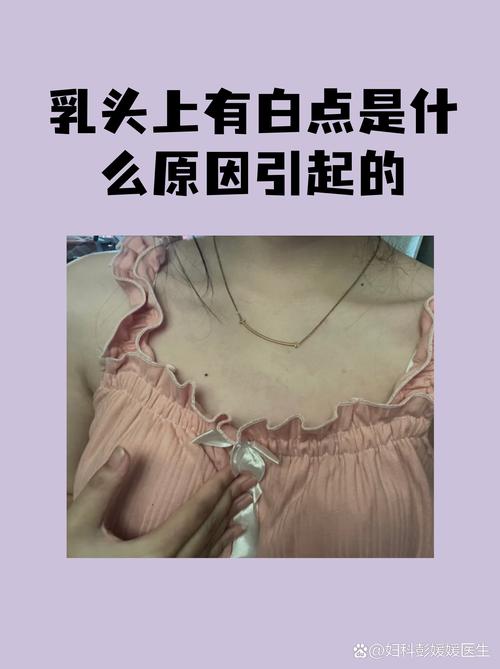 新生儿乳头上出现白点是什么原因？需要处理吗？-第3张图片-郑州医学网