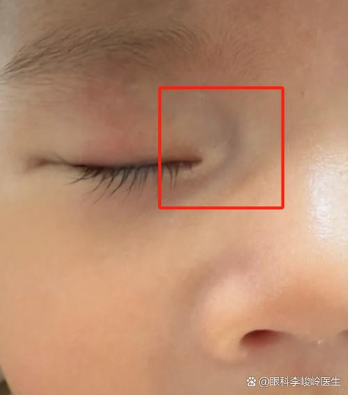 新生儿眼睛下面有条沟是正常生理现象还是异常信号？需警惕哪些潜在问题？-第1张图片-郑州医学网