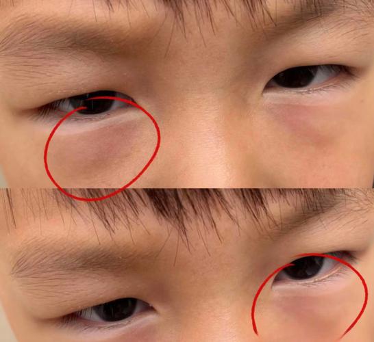 新生儿眼睛下面有条沟是正常生理现象还是异常信号？需警惕哪些潜在问题？-第2张图片-郑州医学网