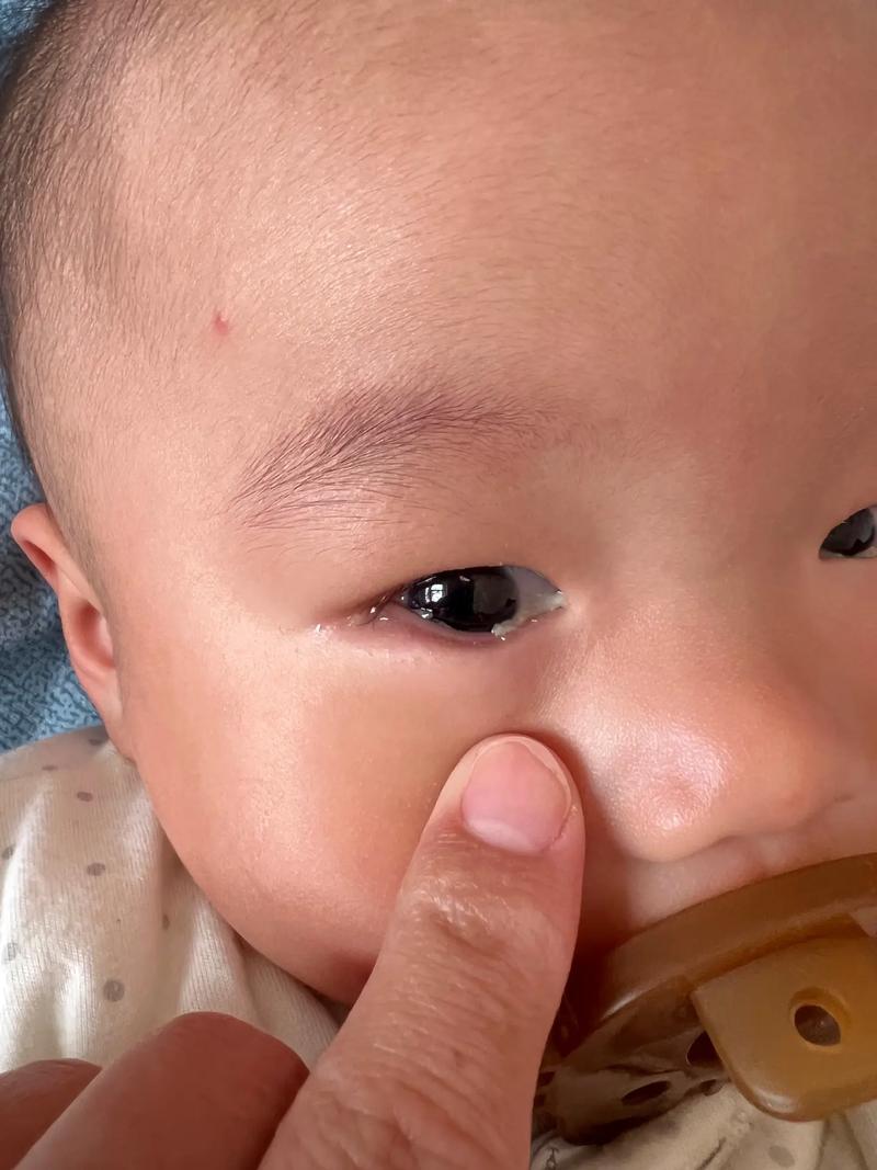新生儿眼睛下面有条沟是正常生理现象还是异常信号？需警惕哪些潜在问题？-第3张图片-郑州医学网