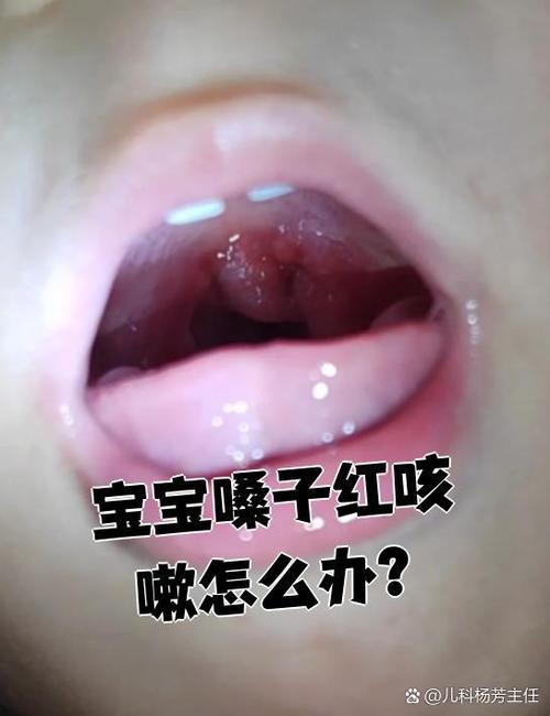 新生儿嗓子红了怎么办?是上火、感染还是其他原因?家长该如何正确处理?-第1张图片-郑州医学网 新生儿嗓子红了怎么办?是上火、感染还是其他原因?家长该如何正确处理?-第1张图片-郑州医学网