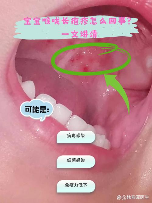 新生儿嗓子红了怎么办?是上火、感染还是其他原因?家长该如何正确处理?-第3张图片-郑州医学网 新生儿嗓子红了怎么办?是上火、感染还是其他原因?家长该如何正确处理?-第3张图片-郑州医学网