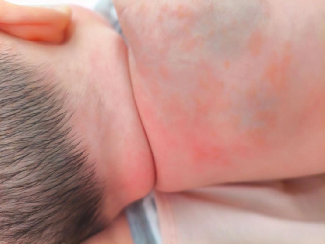 新生儿热疹图片和症状有哪些？如何区分与其他皮疹？-第2张图片-郑州医学网