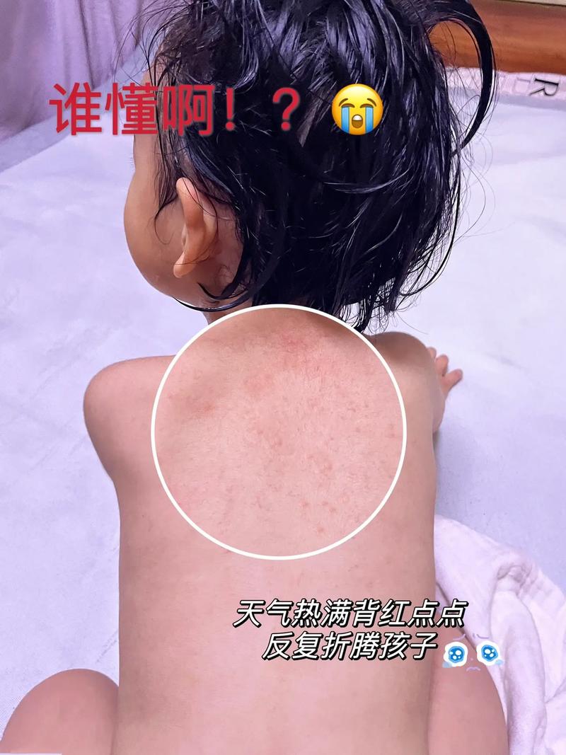 新生儿热疹图片和症状有哪些？如何区分与其他皮疹？-第3张图片-郑州医学网