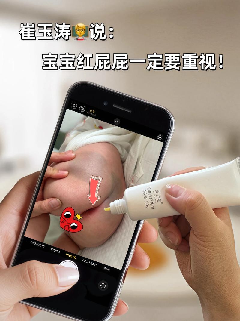 新生儿屁股红到底该擦什么药才安全有效？-第1张图片-郑州医学网