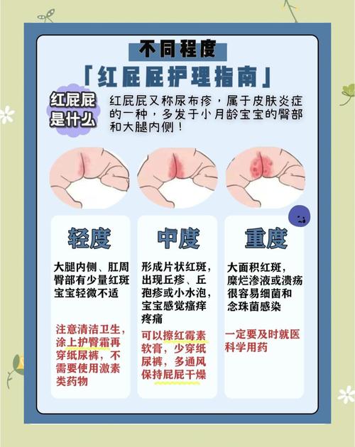 新生儿屁股红到底该擦什么药才安全有效？-第3张图片-郑州医学网