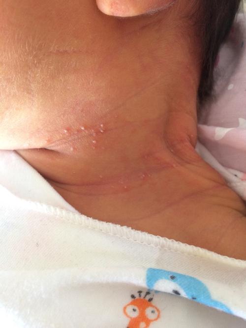新生儿脖子长白色疹子是湿疹还是汗疱疹？需要治疗吗？-第3张图片-郑州医学网