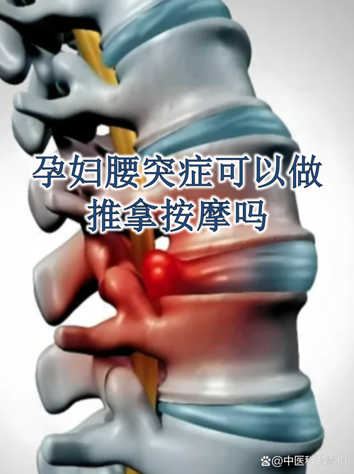 孕期腰椎间盘突出疼痛，该如何缓解才能不影响胎儿健康？-第3张图片-郑州医学网
