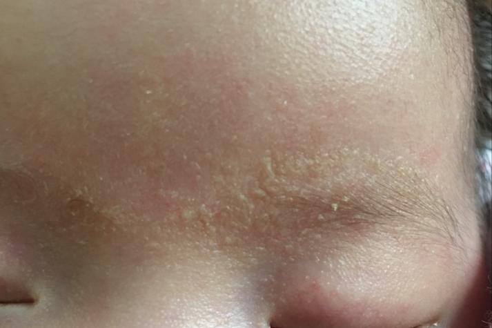 新生儿眉毛上长红疙瘩是湿疹还是过敏？该怎么护理才好？-第1张图片-郑州医学网