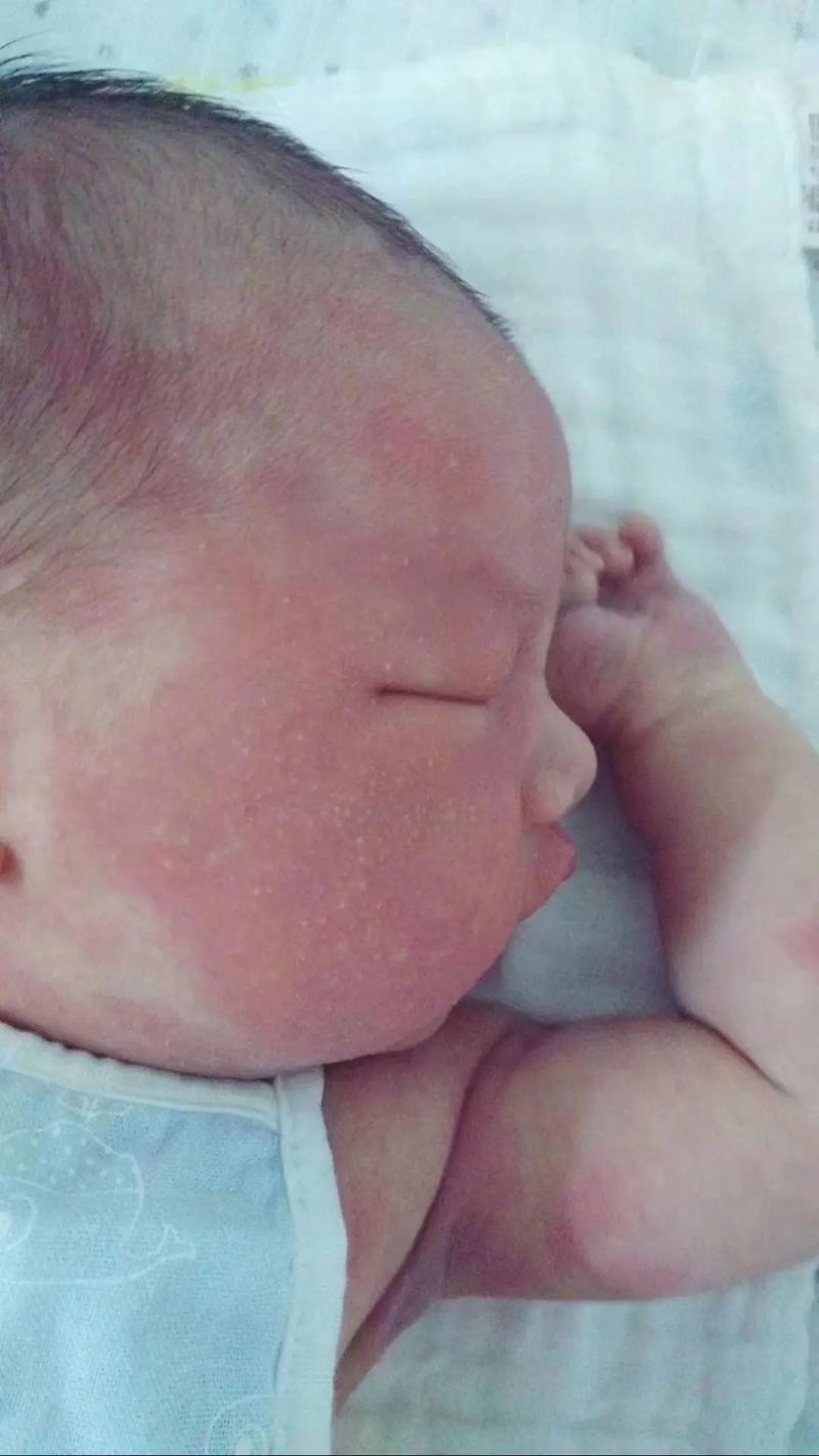 新生儿眉毛上长红疙瘩是湿疹还是过敏？该怎么护理才好？-第3张图片-郑州医学网