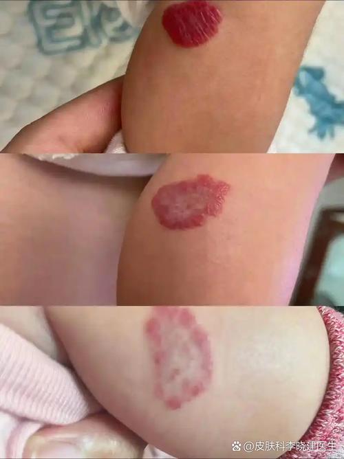 新生儿身上的红胎记会自行消退吗？消失过程需要多久？-第2张图片-郑州医学网
