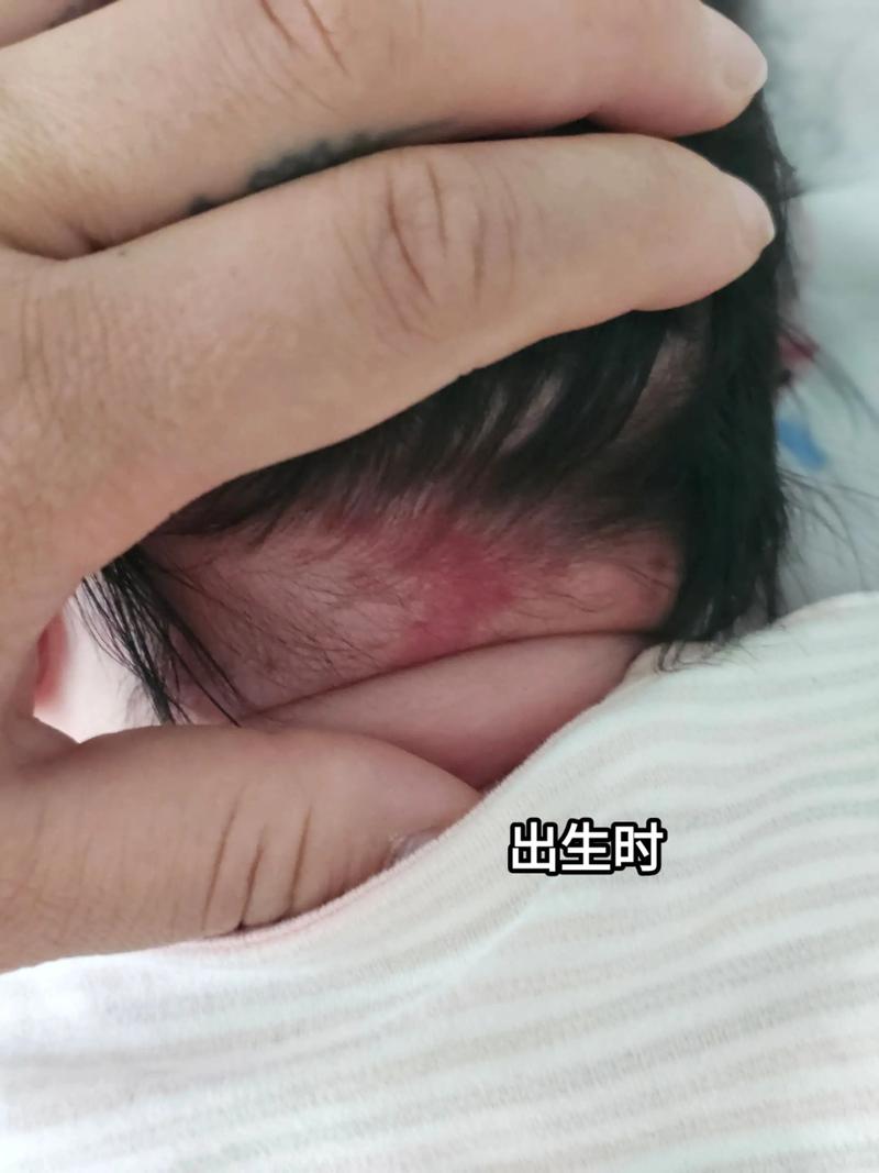 新生儿身上的红胎记会自行消退吗？消失过程需要多久？-第3张图片-郑州医学网