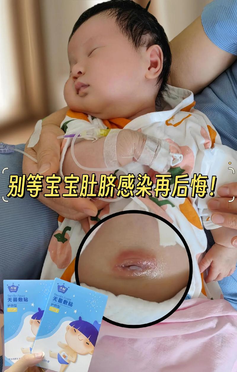 新生儿肚脐有点化脓了,家长该怎么办?需要马上去医院吗?-第1张图片-郑州医学网 新生儿肚脐有点化脓了,家长该怎么办?需要马上去医院吗?-第1张图片-郑州医学网
