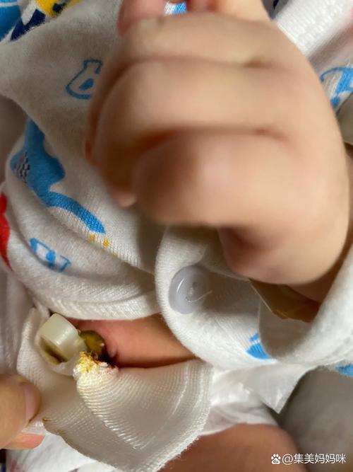 新生儿肚脐有点化脓了,家长该怎么办?需要马上去医院吗?-第3张图片-郑州医学网 新生儿肚脐有点化脓了,家长该怎么办?需要马上去医院吗?-第3张图片-郑州医学网