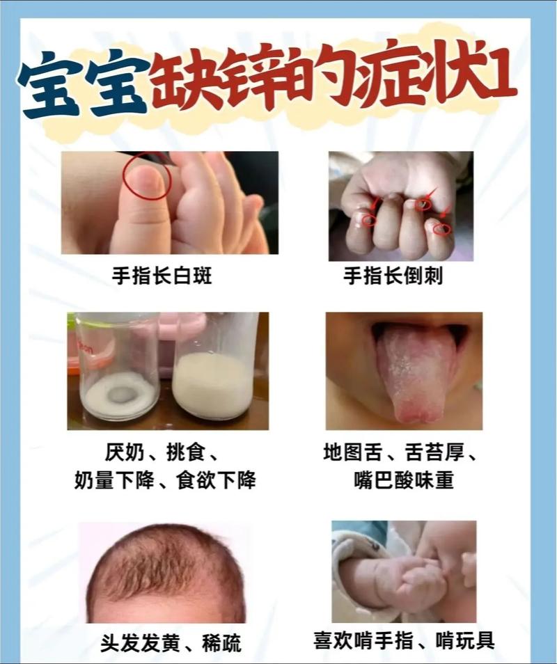儿童缺锌会有哪些典型症状?家长该如何辨别和应对?-第1张图片-郑州医学网 儿童缺锌会有哪些典型症状?家长该如何辨别和应对?-第1张图片-郑州医学网