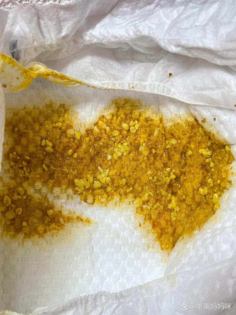 新生儿大便出现白色奶瓣是消化不良还是正常现象?-第2张图片-郑州医学网 新生儿大便出现白色奶瓣是消化不良还是正常现象?-第2张图片-郑州医学网