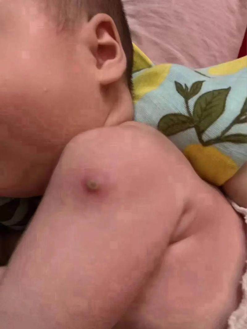 新生儿预防针化脓是正常现象吗?图片显示这种情况该如何处理?-第1张图片-郑州医学网 新生儿预防针化脓是正常现象吗?图片显示这种情况该如何处理?-第1张图片-郑州医学网