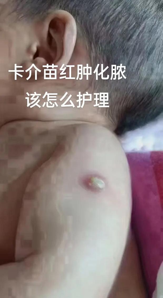 新生儿预防针化脓是正常现象吗？图片显示这种情况该如何处理？-第2张图片-郑州医学网