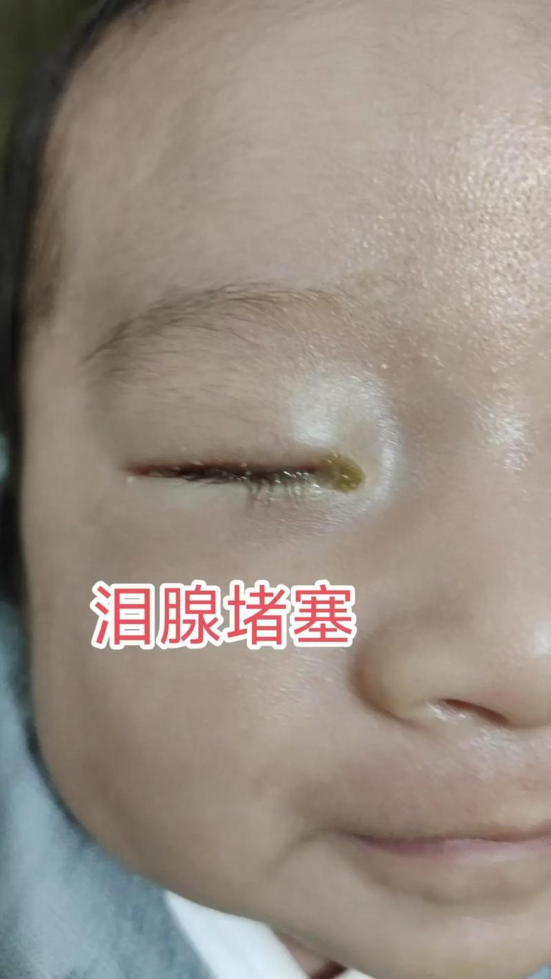 新生儿泪腺炎按摩视频操作手法是否正确?需注意哪些风险事项?-第2张图片-郑州医学网 新生儿泪腺炎按摩视频操作手法是否正确?需注意哪些风险事项?-第2张图片-郑州医学网