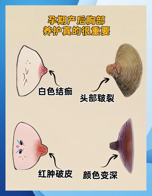 孕期乳头结痂正常吗？需要处理吗？怎么护理才能缓解不适？-第3张图片-郑州医学网