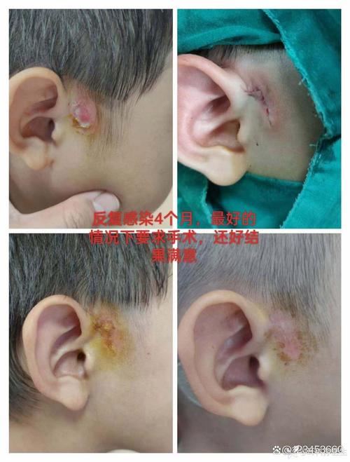 新生儿耳前瘘管不处理会引发哪些严重危害？-第2张图片-郑州医学网