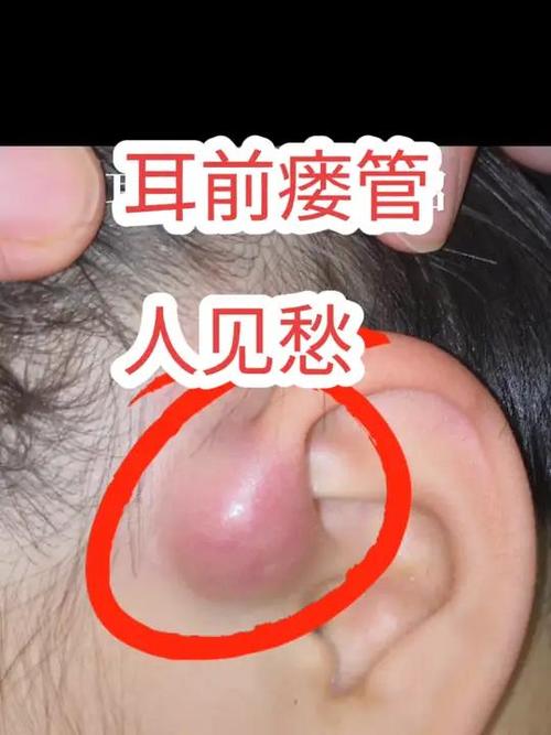 新生儿耳前瘘管不处理会引发哪些严重危害？-第1张图片-郑州医学网