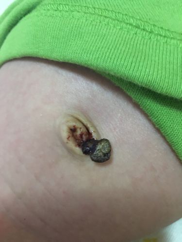 新生儿7天肚脐有血水是正常现象还是异常信号？需如何处理？-第2张图片-郑州医学网