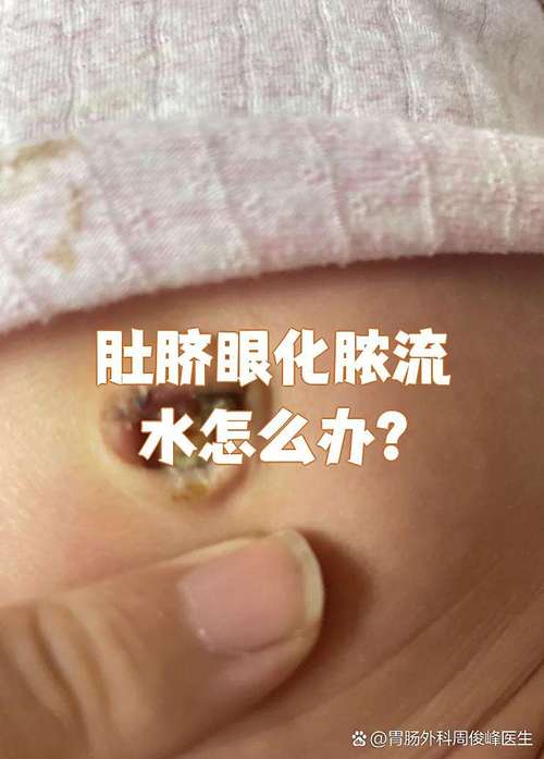 新生儿7天肚脐有血水是正常现象还是异常信号？需如何处理？-第3张图片-郑州医学网