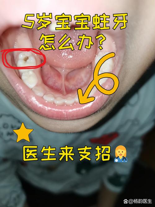 儿童蛀牙治疗的最佳方法是什么？不同年龄段孩子蛀牙处理方式有何差异？-第3张图片-郑州医学网