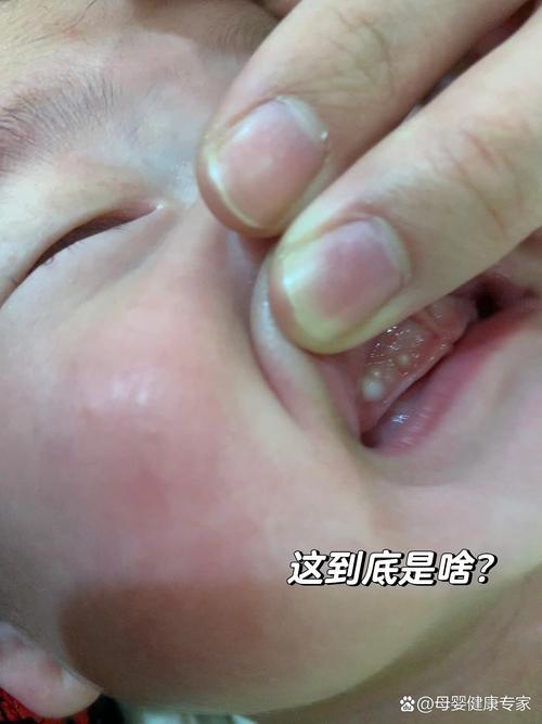 新生儿下牙龈出现小白点是什么原因？需要担心吗？-第1张图片-郑州医学网