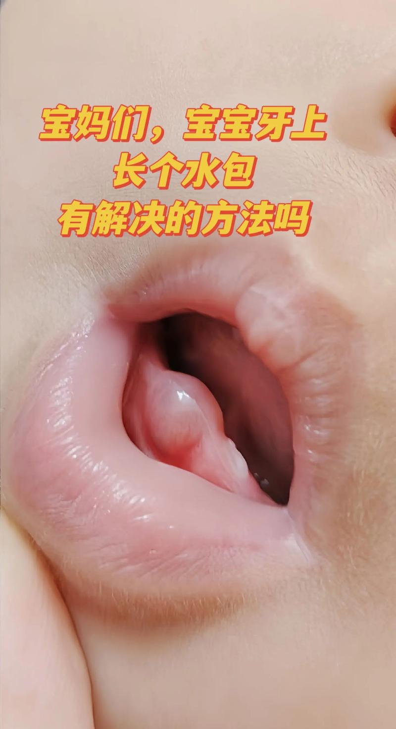 新生儿下牙龈出现小白点是什么原因？需要担心吗？-第2张图片-郑州医学网